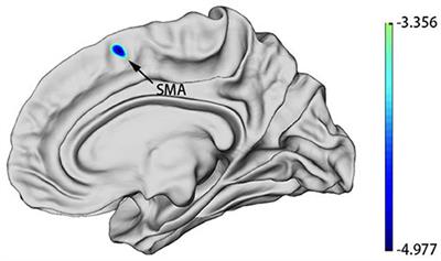 Cortical Thickness Predicts Response Following 2 Weeks of SSRI Regimen in First-Episode, Drug-Naive Major Depressive Disorder: An MRI Study